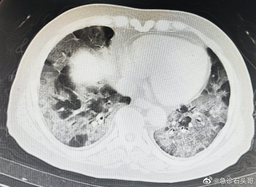 白肺的一个明显表现是气紧 没有白肺症状用做CT吗？
