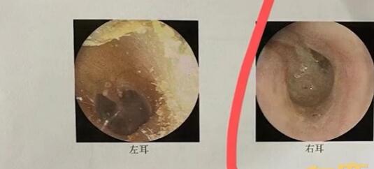 老太误将502胶当滴耳液滴满耳道 这一危险举动令人后怕