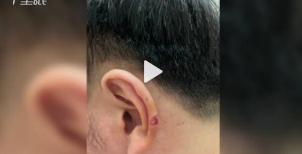 男子理发时耳朵被剪掉一块肉 理发店仅赔偿200元医药费