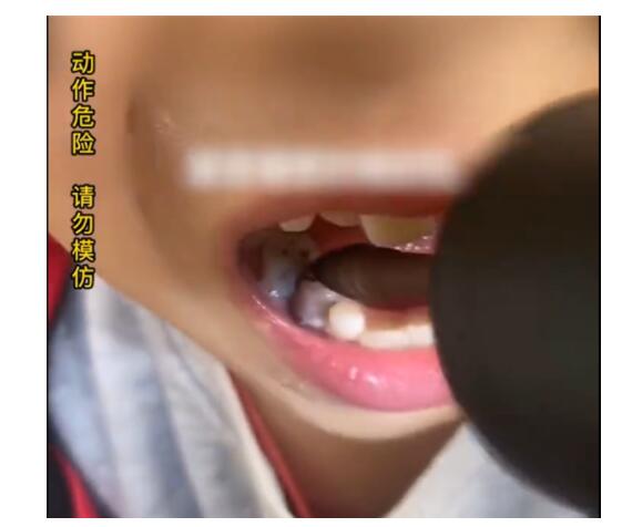 男孩长蛀牙爸爸用电钻钻牙止痛 这样无知的父母真的是太可怕了