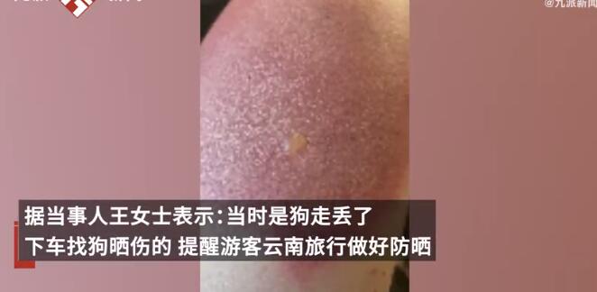 女子云南穿破洞裤7小时腿被晒伤 医生诊断为二级烫伤夏季出门千万要做好防晒